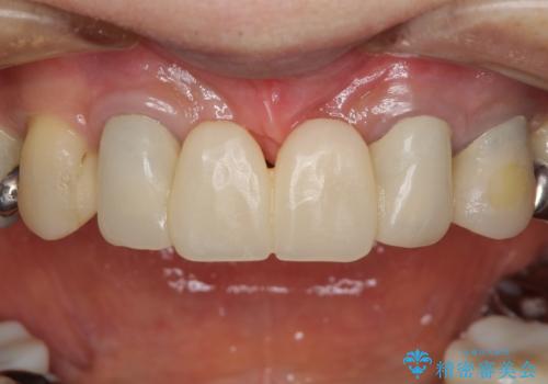 話しにくく腫れやすい前歯のブリッジ 使用感の良いオールセラミックブリッジにの治療前