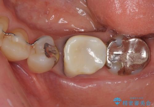 話しにくく腫れやすい前歯のブリッジ 使用感の良いオールセラミックブリッジにの治療前