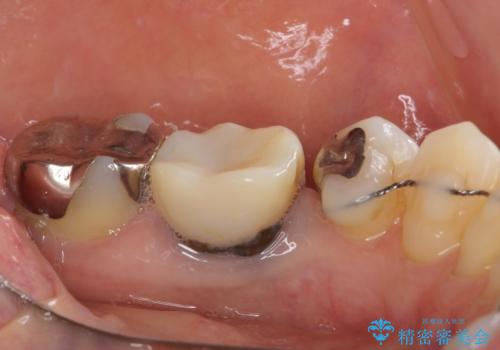 話しにくく腫れやすい前歯のブリッジ 使用感の良いオールセラミックブリッジにの治療前
