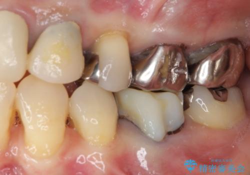 話しにくく腫れやすい前歯のブリッジ 使用感の良いオールセラミックブリッジにの治療前