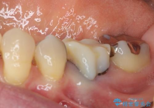 話しにくく腫れやすい前歯のブリッジ 使用感の良いオールセラミックブリッジにの治療前