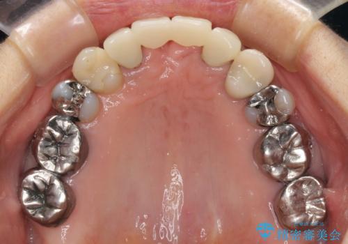 話しにくく腫れやすい前歯のブリッジ 使用感の良いオールセラミックブリッジにの治療前