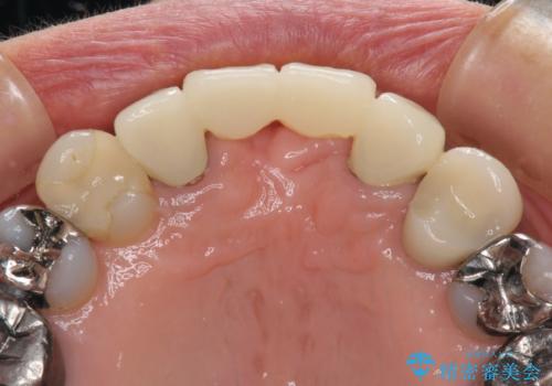 話しにくく腫れやすい前歯のブリッジ　使用感の良いオールセラミックブリッジにの治療前