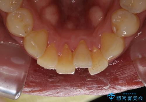 結婚式前にクリーニング希望の方の治療前