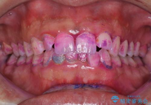 結婚式前にクリーニング希望の方の症例 治療前