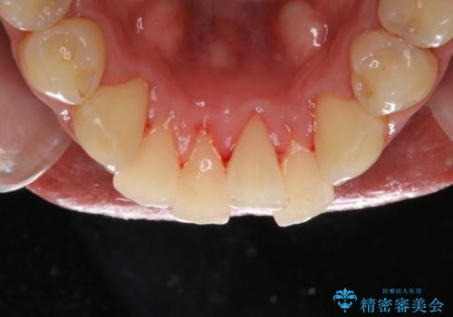 結婚式前にクリーニング希望の方の治療後