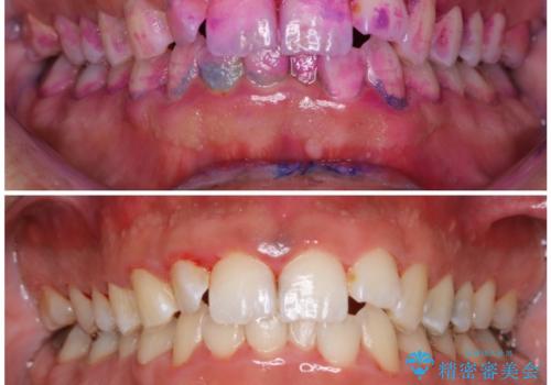 結婚式前にクリーニング希望の方の治療前