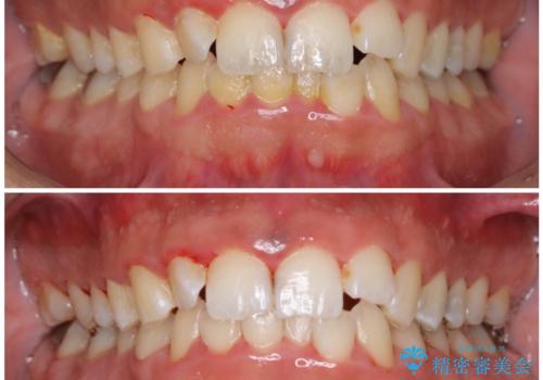 結婚式前にクリーニング希望の方の治療後