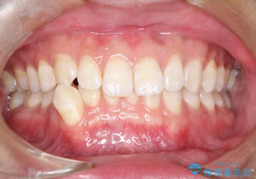 前歯がガタガタ インビザラインによる矯正の治療前