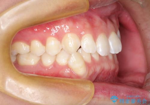 前歯がガタガタ インビザラインによる矯正の治療前
