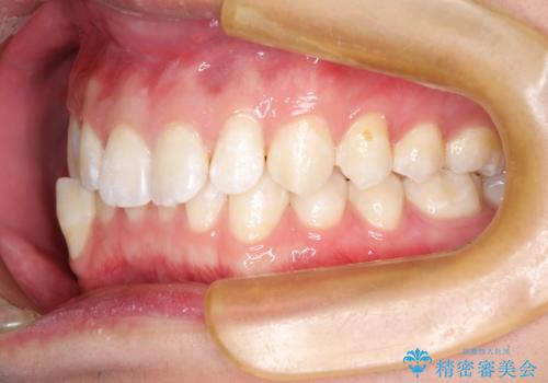 前歯がガタガタ　インビザラインによる矯正の治療前