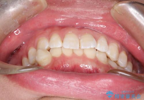 前歯がガタガタ　インビザラインによる矯正の治療前
