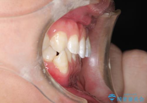 前歯がガタガタ インビザラインによる矯正の治療前