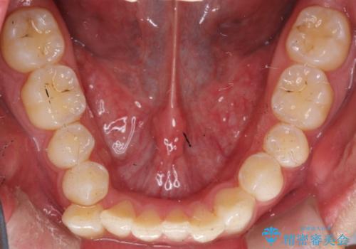 前歯がガタガタ インビザラインによる矯正の治療前