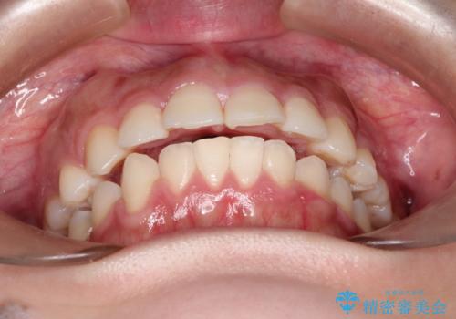 矯正治療後の後戻り インビザラインにて再矯正の治療前