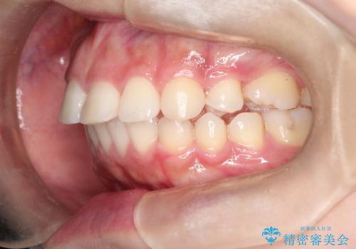 矯正治療後の後戻り インビザラインにて再矯正の治療前