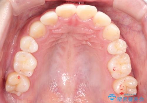 矯正治療後の後戻り インビザラインにて再矯正の治療前