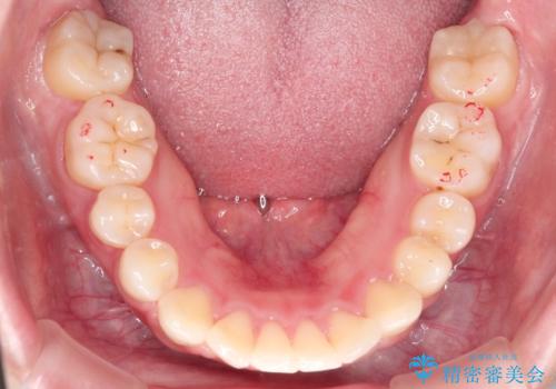 矯正治療後の後戻り インビザラインにて再矯正の治療前