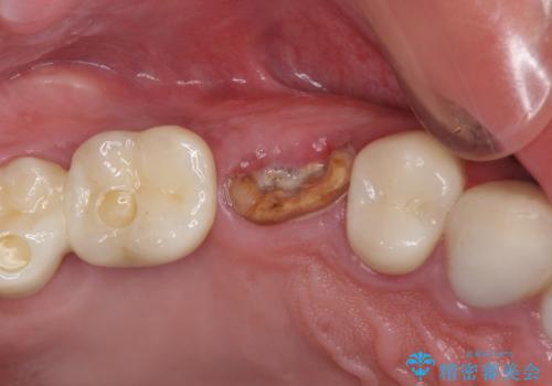 折れてしまった歯 インプラントによる補綴治療の症例 治療前