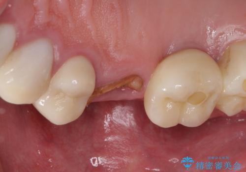 折れてしまった歯 インプラントによる補綴治療の治療前