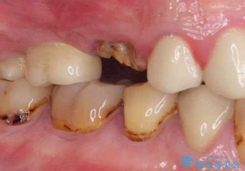 折れてしまった歯 インプラントによる補綴治療の治療前
