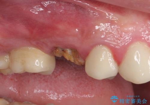 折れてしまった歯 インプラントによる補綴治療の治療前