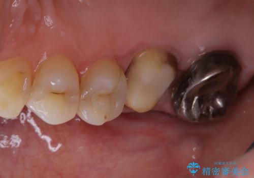 歯ぐきにニキビのようなものができた:原因から改善、被せ物までの治療中
