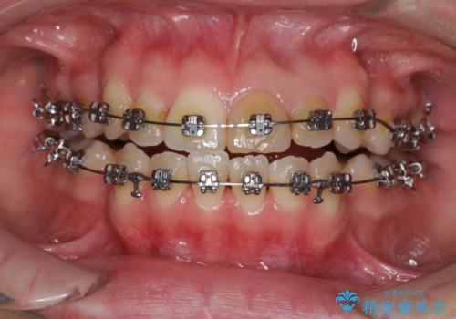 八重歯の抜歯矯正 費用を抑えた矯正装置の治療中