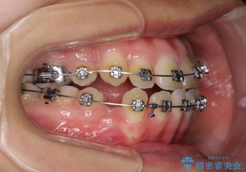 八重歯の抜歯矯正 費用を抑えた矯正装置の治療中