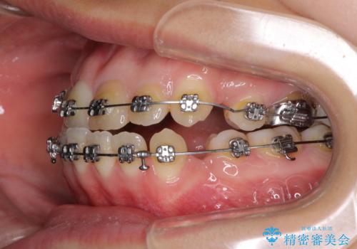 八重歯の抜歯矯正 費用を抑えた矯正装置の治療中