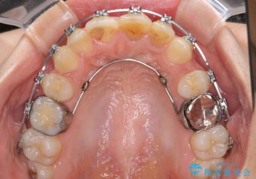 八重歯の抜歯矯正 費用を抑えた矯正装置の治療中