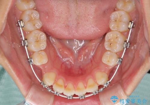 八重歯の抜歯矯正　費用を抑えた矯正装置の治療中