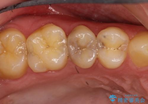 虫歯をなおしたい、セラミックインレー修復の症例 治療前