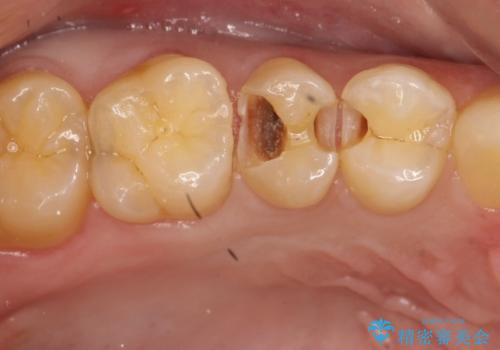 虫歯をなおしたい、セラミックインレー修復の治療中