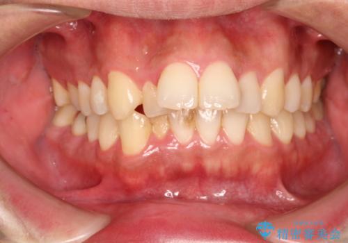 出っ歯の抜歯矯正 裏側ワイヤーによる目立たない矯正の治療前