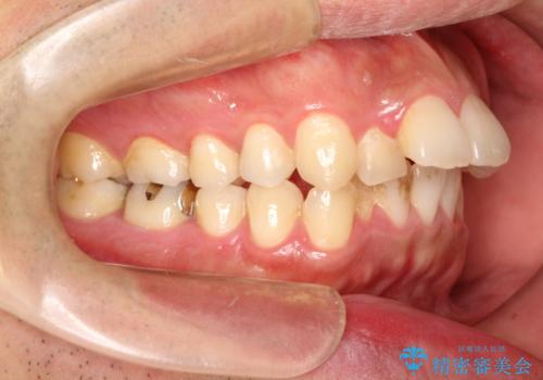 出っ歯の抜歯矯正　裏側ワイヤーによる目立たない矯正の治療前