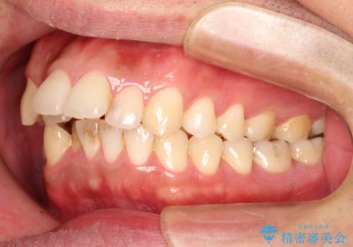 出っ歯の抜歯矯正 裏側ワイヤーによる目立たない矯正の治療前