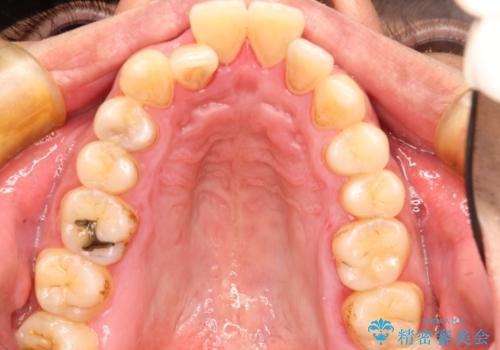 出っ歯の抜歯矯正　裏側ワイヤーによる目立たない矯正の治療前