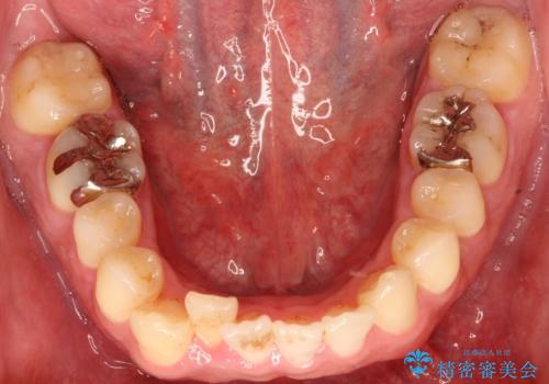 出っ歯の抜歯矯正 裏側ワイヤーによる目立たない矯正の治療前