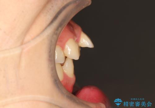 出っ歯の抜歯矯正 裏側ワイヤーによる目立たない矯正の治療前