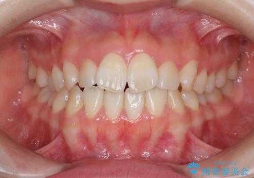 気になる前歯をインビザラインで綺麗にの治療前