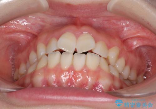 気になる前歯をインビザラインで綺麗にの治療前