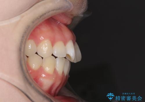 気になる前歯をインビザラインで綺麗にの治療前