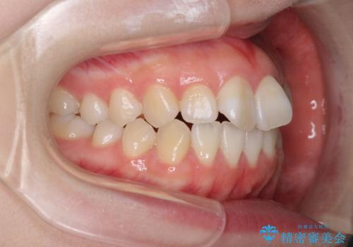 気になる前歯をインビザラインで綺麗にの治療前