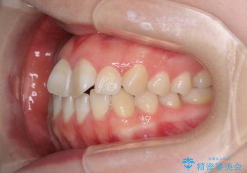 気になる前歯をインビザラインで綺麗にの治療前