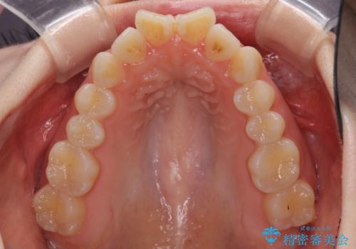 気になる前歯をインビザラインで綺麗にの治療前