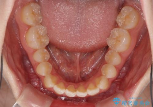 気になる前歯をインビザラインで綺麗にの治療前