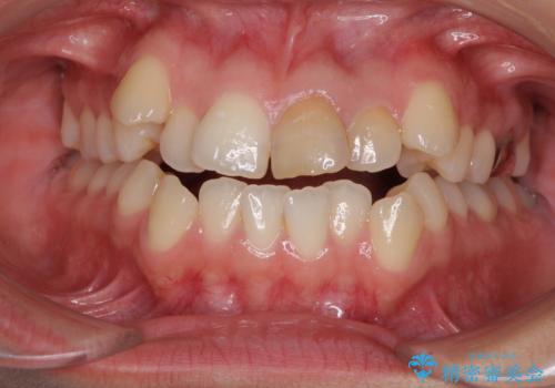八重歯の抜歯矯正　費用を抑えた矯正装置の症例 治療前