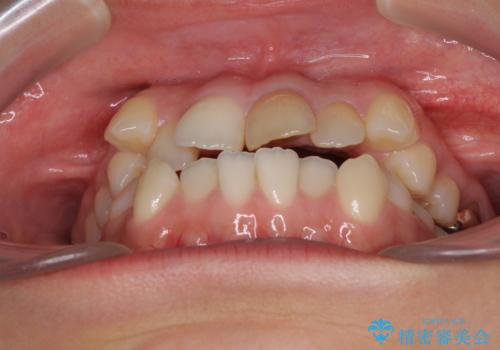 八重歯の抜歯矯正　費用を抑えた矯正装置の治療前