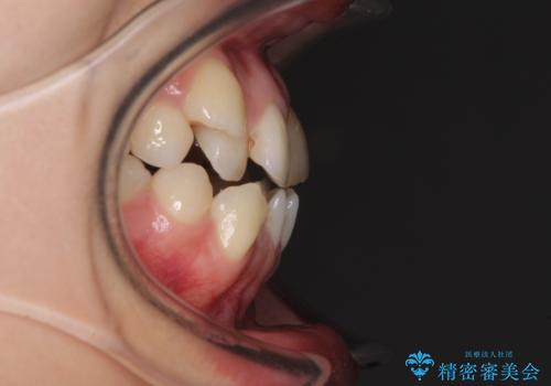 八重歯の抜歯矯正　費用を抑えた矯正装置の治療前
